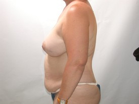 Tummy Tuck before and after - before