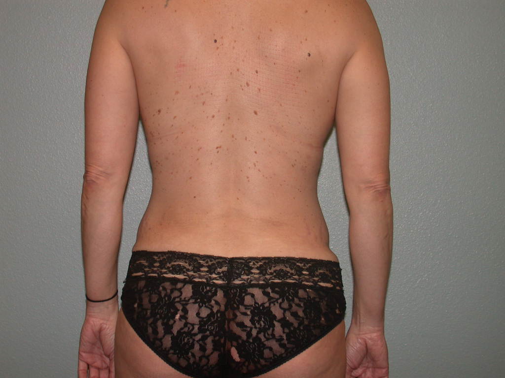 Tummy Tuck after — Dr. Howard Gross