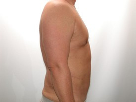 Liposuction before and after - after