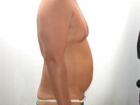 Liposuction before and after - before