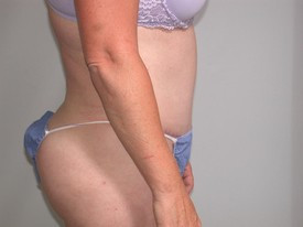 Tummy Tuck before and after - after