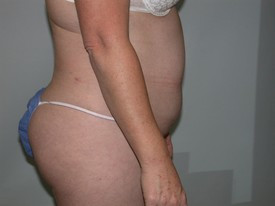 Tummy Tuck before and after - before