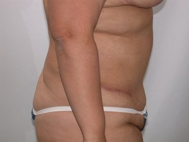 Tummy Tuck before and after - after