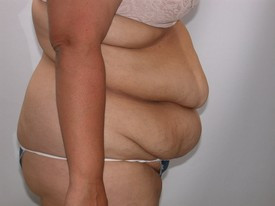 Tummy Tuck before and after - before