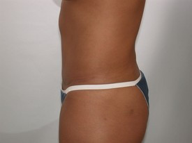 Tummy Tuck before and after - after