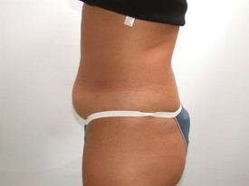 Tummy Tuck before and after - before