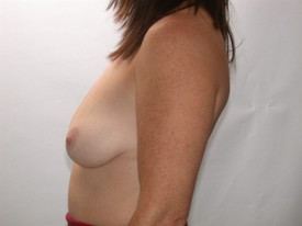 Breast Lift before and after - before