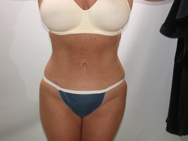 Liposuction before and after - after