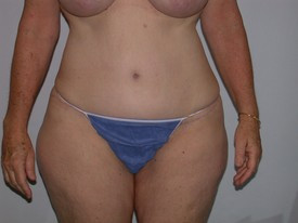 Tummy Tuck before and after - after