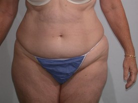 Tummy Tuck before and after - before