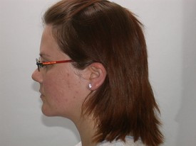 Chin and Cheek Implants before and after - after