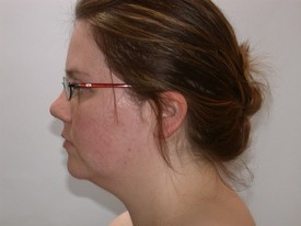 Chin and Cheek Implants before and after - before