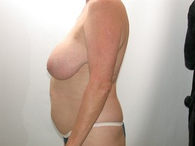 Liposuction before — Dr. Howard Gross
