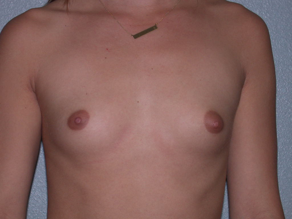 Breast Augmentation before and after - before