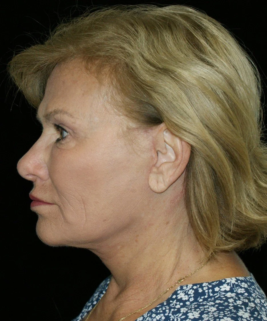 Facelift after — Dr. Thomas Toohey