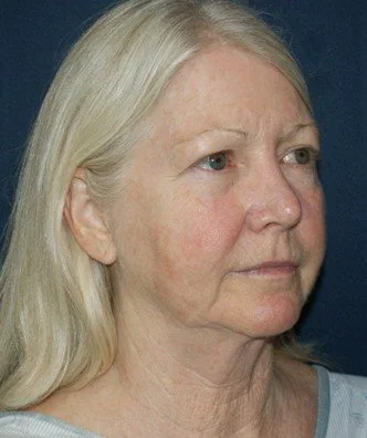 Facelift before — Dr. Thomas Toohey