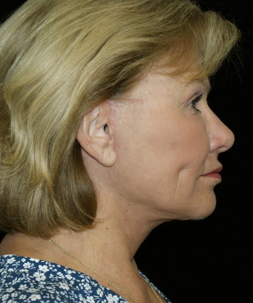 Facelift after — Dr. Thomas Toohey