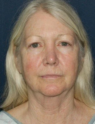 Facelift before — Dr. Thomas Toohey