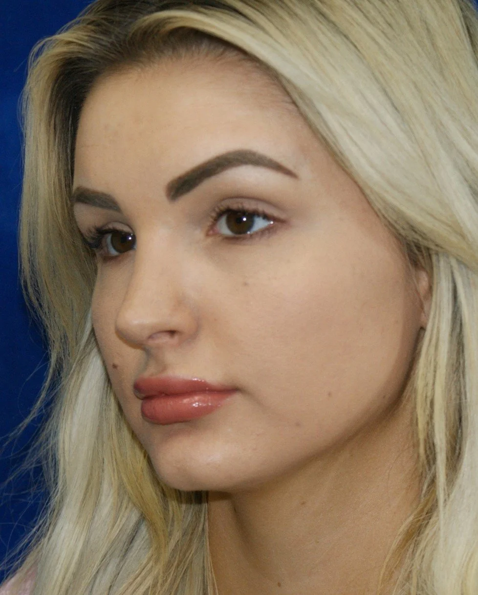 Rhinoplasty after — Dr. Thomas Toohey