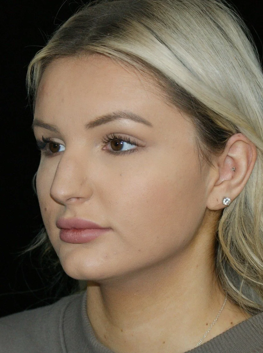 Rhinoplasty before — Dr. Thomas Toohey