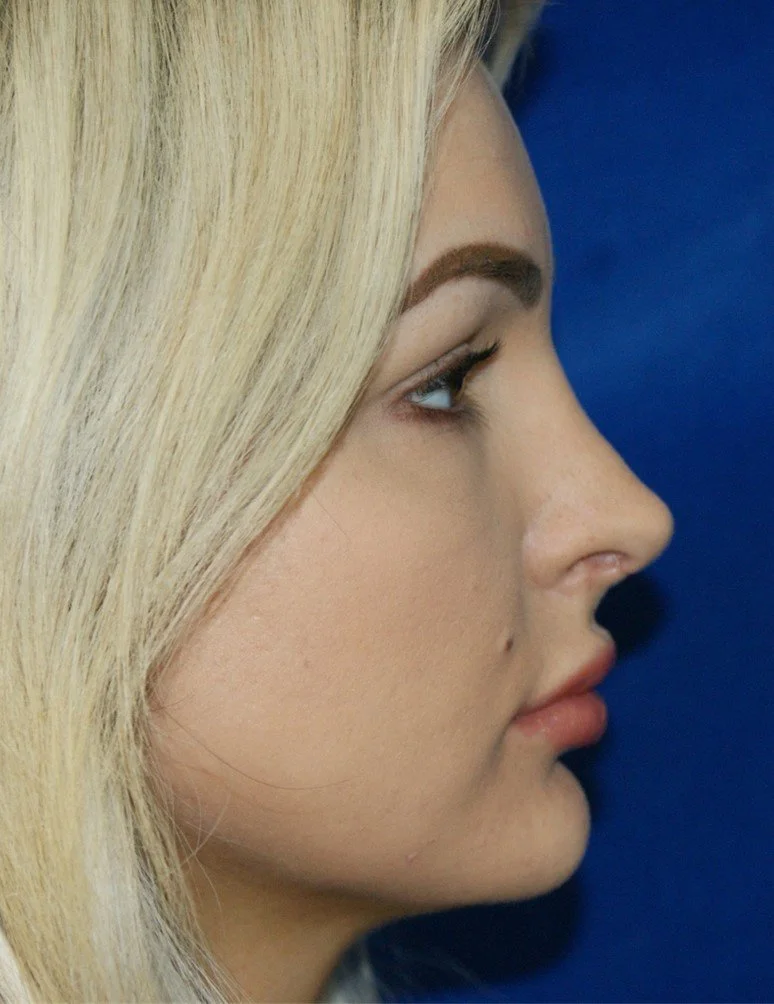 Rhinoplasty after — Dr. Thomas Toohey
