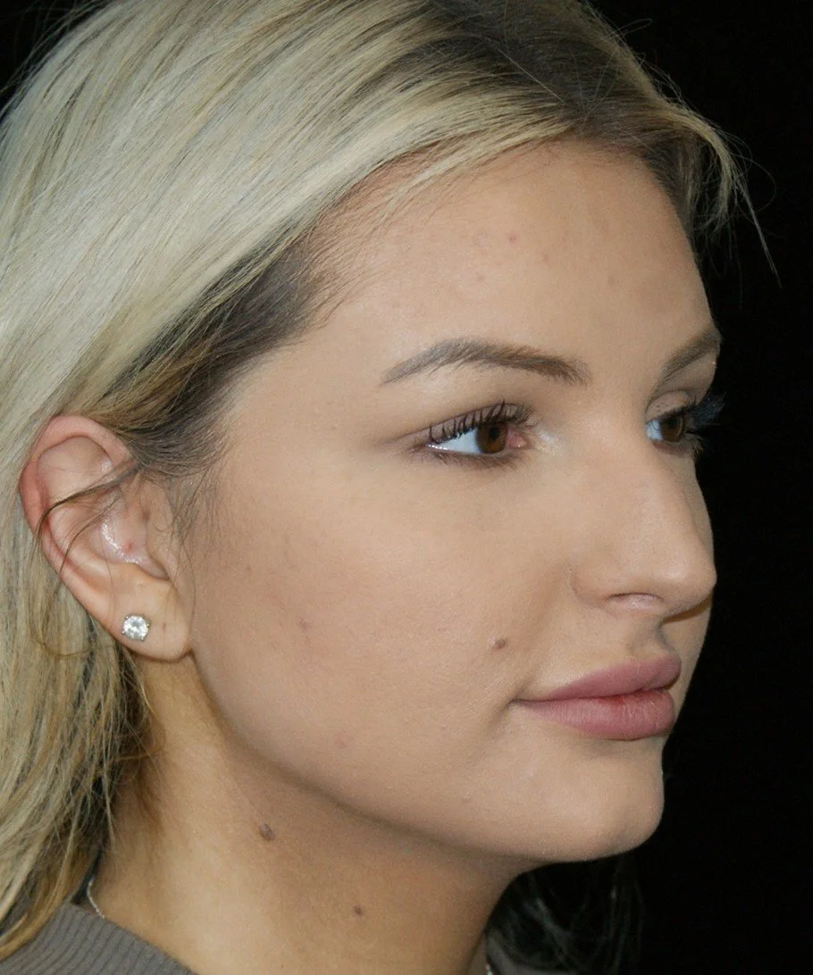 Rhinoplasty before — Dr. Thomas Toohey
