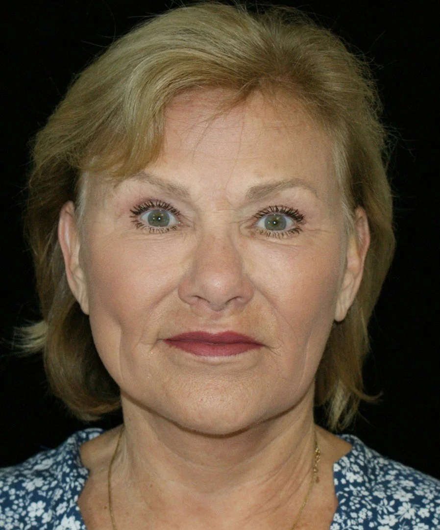 Facelift after — Dr. Thomas Toohey