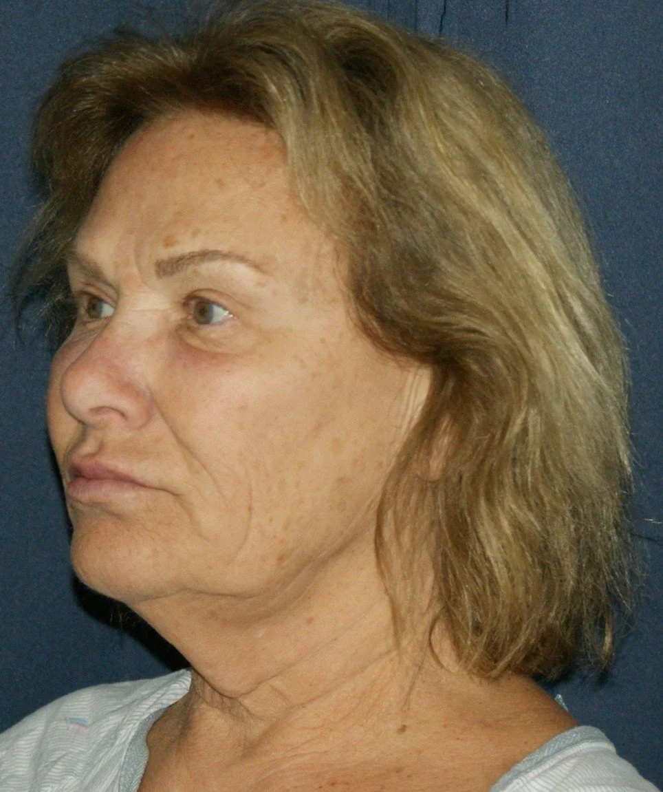 Facelift before — Dr. Thomas Toohey