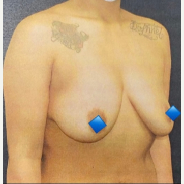 Procedure before and after - before
