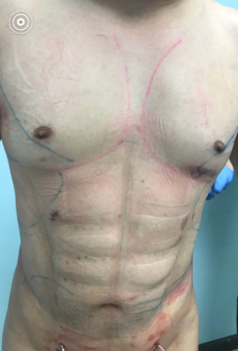 Liposuction before and after - after