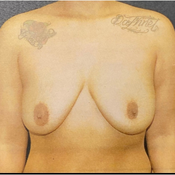 Breast Lift before and after - before