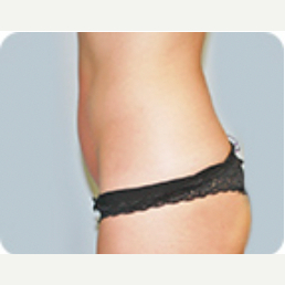 Procedure before and after - after