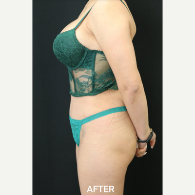 Tummy Tuck before and after - after