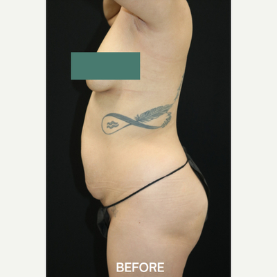 Tummy Tuck before and after - before