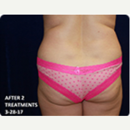 Liposuction before and after - after