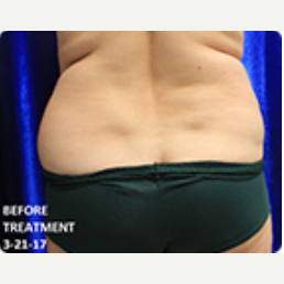Liposuction before and after - before