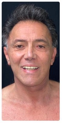 Procedure before and after - after
