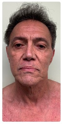 Procedure before and after - before