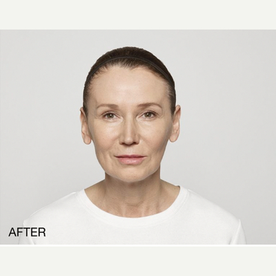 Procedure before and after - after