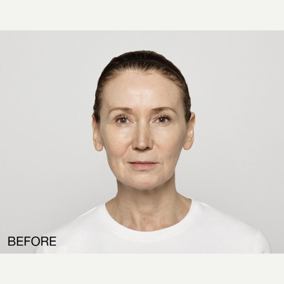 Procedure before and after - before