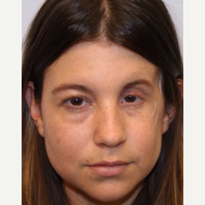 Procedure before and after - before