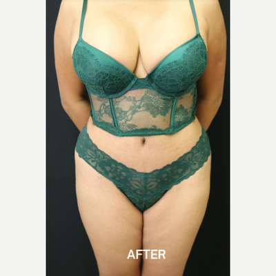 Procedure before and after - after