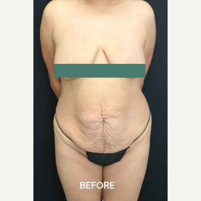 Procedure before and after - before