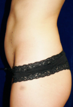 Procedure before and after - before