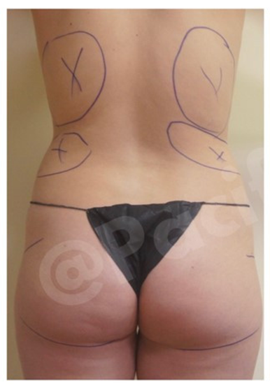 Procedure before and after - before