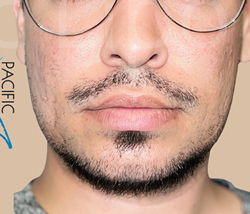 Procedure before and after - after