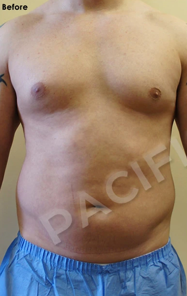 Procedure before and after - before