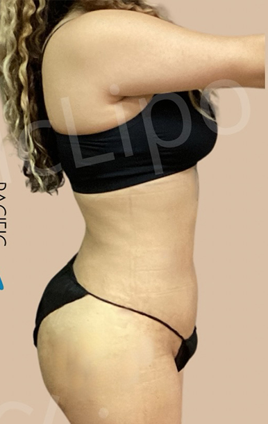 Procedure before and after - after