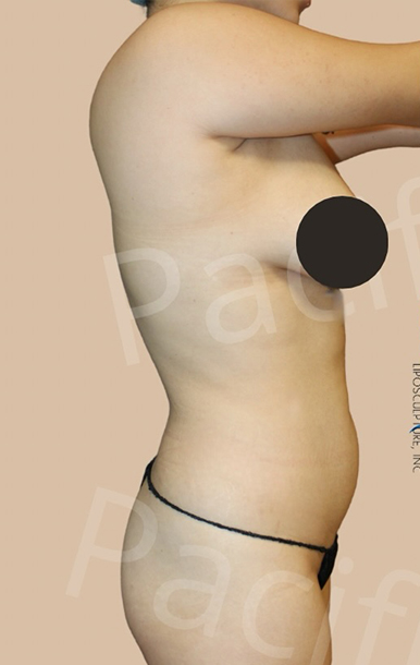 Procedure before and after - before