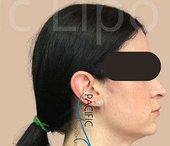 Procedure before and after - after